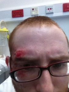 My face after a slight accident.